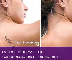 Tattoo Removal in Carrownamaddra (Connaught)