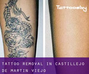 Tattoo Removal in Castillejo de Martín Viejo