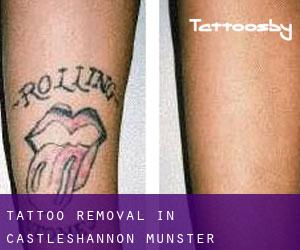 Tattoo Removal in Castleshannon (Munster)