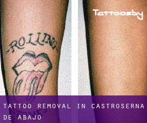 Tattoo Removal in Castroserna de Abajo
