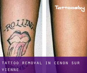 Tattoo Removal in Cenon-sur-Vienne