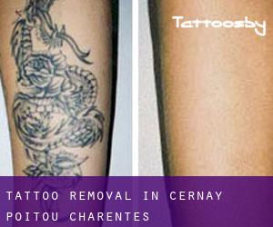 Tattoo Removal in Cernay (Poitou-Charentes)