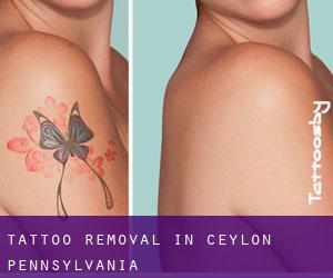 Tattoo Removal in Ceylon (Pennsylvania)