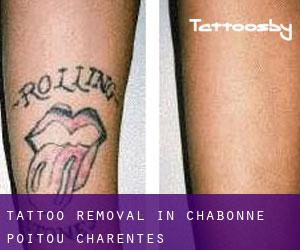 Tattoo Removal in Chabonne (Poitou-Charentes)