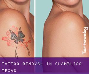 Tattoo Removal in Chambliss (Texas)