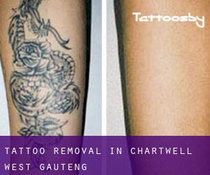 Tattoo Removal in Chartwell West (Gauteng)