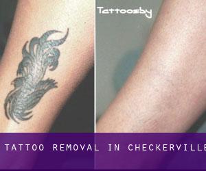 Tattoo Removal in Checkerville