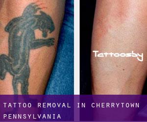 Tattoo Removal in Cherrytown (Pennsylvania)