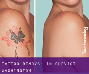 Tattoo Removal in Cheviot (Washington)