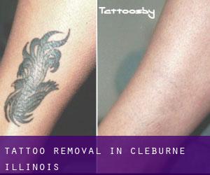 Tattoo Removal in Cleburne (Illinois)