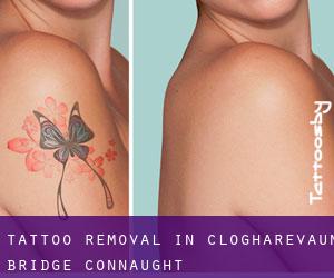 Tattoo Removal in Clogharevaun Bridge (Connaught)