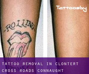 Tattoo Removal in Clontert Cross Roads (Connaught)