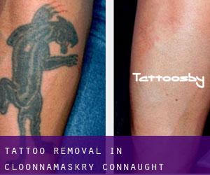 Tattoo Removal in Cloonnamaskry (Connaught)