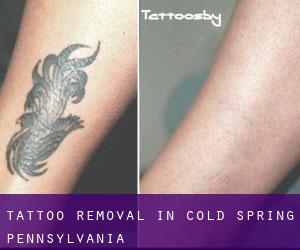 Tattoo Removal in Cold Spring (Pennsylvania)