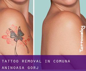 Tattoo Removal in Comuna Aninoasa (Gorj)