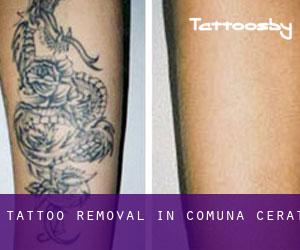 Tattoo Removal in Comuna Cerãt