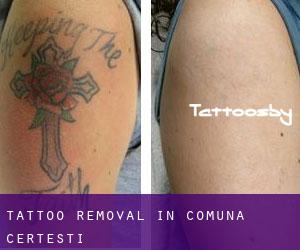Tattoo Removal in Comuna Cerţeşti