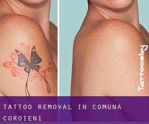 Tattoo Removal in Comuna Coroieni