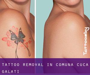 Tattoo Removal in Comuna Cuca (Galaţi)