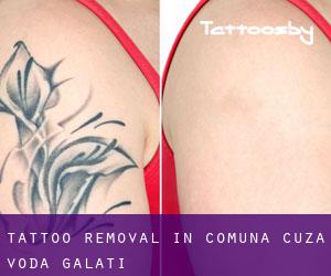 Tattoo Removal in Comuna Cuza Vodă (Galaţi)
