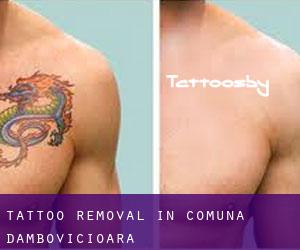 Tattoo Removal in Comuna Dâmbovicioara