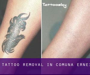 Tattoo Removal in Comuna Ernei
