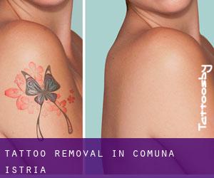 Tattoo Removal in Comuna Istria