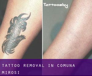 Tattoo Removal in Comuna Miroşi