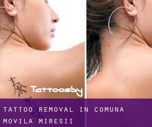 Tattoo Removal in Comuna Movila Miresii