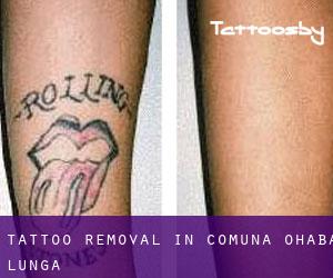 Tattoo Removal in Comuna Ohaba Lungă