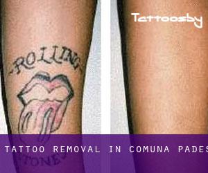 Tattoo Removal in Comuna Padeş