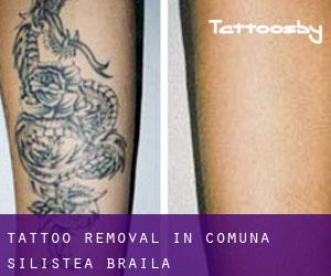 Tattoo Removal in Comuna Siliştea (Brăila)