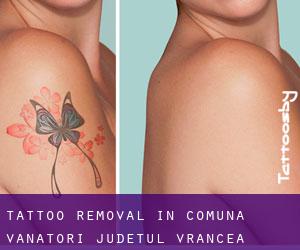 Tattoo Removal in Comuna Vânători (Judeţul Vrancea)