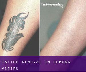 Tattoo Removal in Comuna Viziru