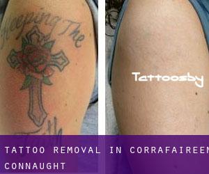 Tattoo Removal in Corrafaireen (Connaught)