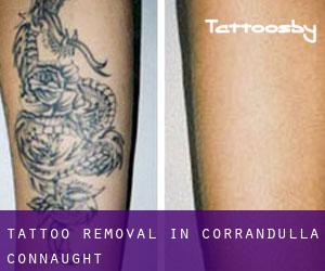 Tattoo Removal in Corrandulla (Connaught)