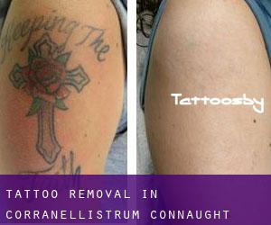 Tattoo Removal in Corranellistrum (Connaught)