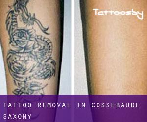 Tattoo Removal in Cossebaude (Saxony)