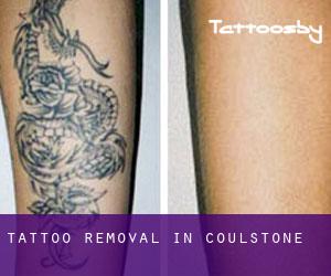 Tattoo Removal in Coulstone