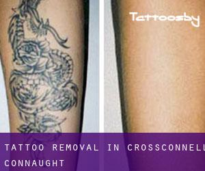 Tattoo Removal in Crossconnell (Connaught)