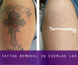 Tattoo Removal in Cuerlas (Las)
