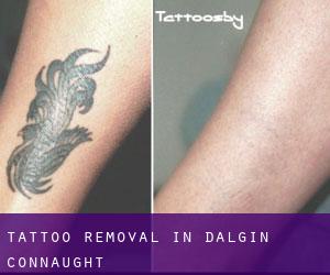 Tattoo Removal in Dalgin (Connaught)