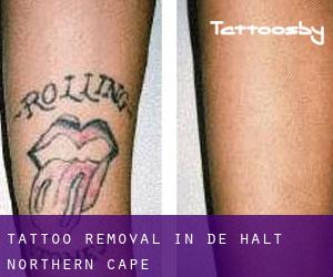 Tattoo Removal in De Halt (Northern Cape)