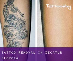 Tattoo Removal in Decatur (Georgia)