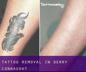 Tattoo Removal in Derry (Connaught)