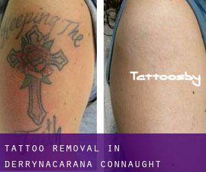 Tattoo Removal in Derrynacarana (Connaught)