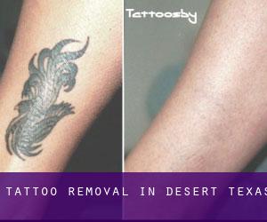 Tattoo Removal in Desert (Texas)