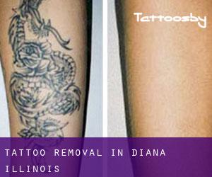 Tattoo Removal in Diana (Illinois)