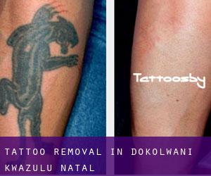 Tattoo Removal in Dokolwani (KwaZulu-Natal)