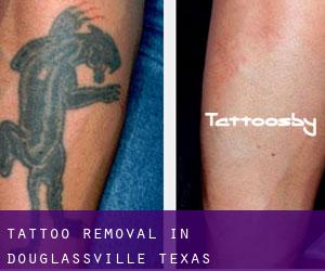 Tattoo Removal in Douglassville (Texas)